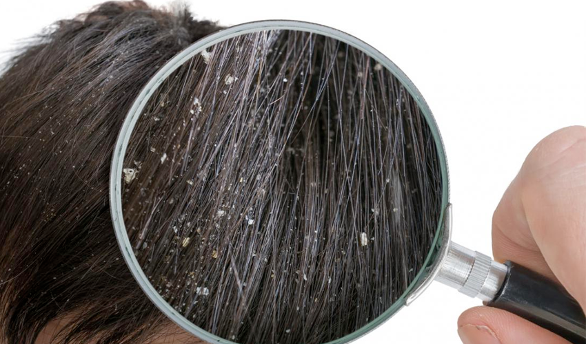 താരനെ പ്രതിരോധിക്കാന്‍