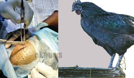 കോഴിക്ക് ശസ്ത്രക്രിയ; 410 ഗ്രാം അവശിഷ്ടങ്ങൾ  നീക്കം ചെയ്തു