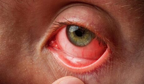 700 Black fungus cases in 7 days in Karnataka