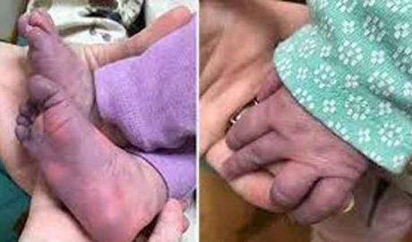 കുട്ടികളിലെ മൾട്ടിസിസ്റ്റം ഇൻഫ്ലമേറ്ററി സിൻഡ്രോം (MIS-C); രോഗലക്ഷണങ്ങൾ