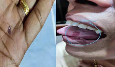 മിൽമ മിൽക്ക്പേടയിൽ കുപ്പിച്ചില്ല്; വീട്ടമ്മയുടെ നാവ് മുറിഞ്ഞു” മിൽമക്കെതിരെ  പരാതി